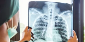 Nuevo tratamiento aumenta la supervivencia en pacientes con cáncer de pulmón